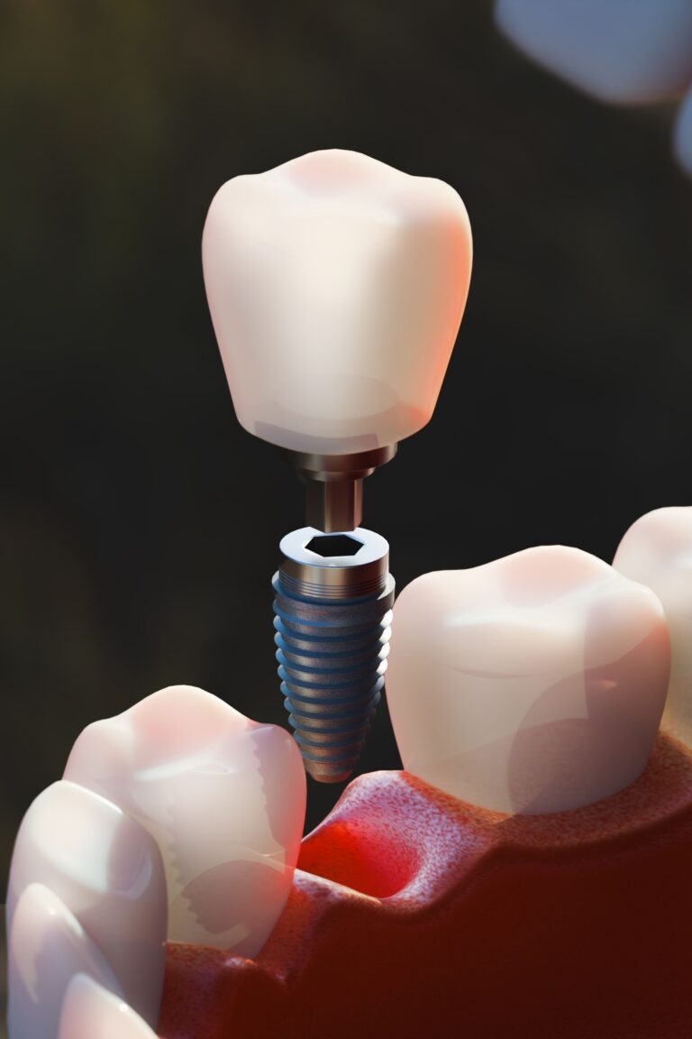 Tightening the screws on implant providers
